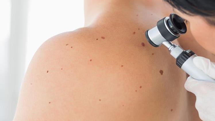 How Often Should You Get a Screening for Skin Cancer - How Often Should You Get a Screening for Skin Cancer?